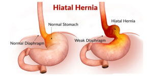 Mide Fıtığı (Hiatal Herni) Nedir? Reflü ile İlişkisi ve Tedavi Yolları