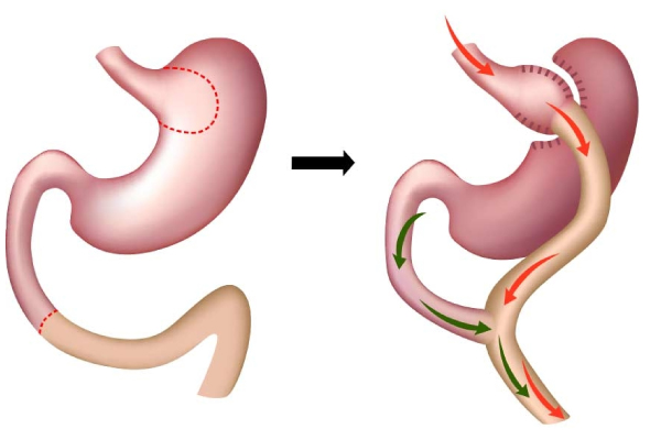 Gastrik Bypass Ameliyatı