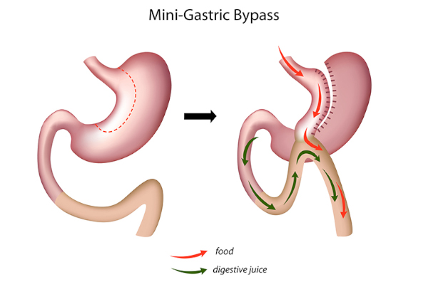 Mini Gastrik Bypass